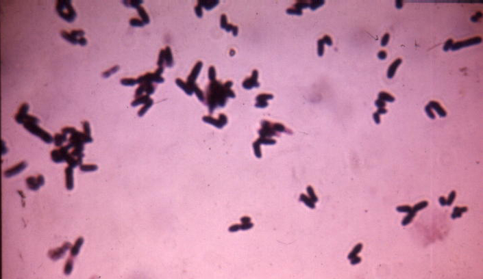 Gram stain of Corynebacterium spp demonstrating Chinese letters 
